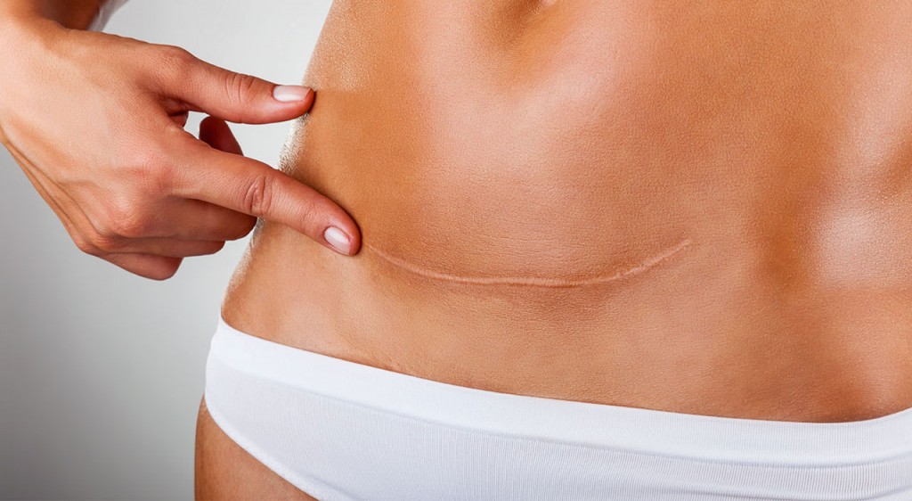tummy tuck
